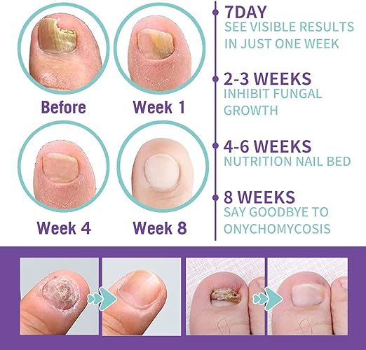 Anti-Pilz Fuß & Nagelspray™ 👣