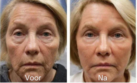 Anti-Falten Botox Gesichtsserum