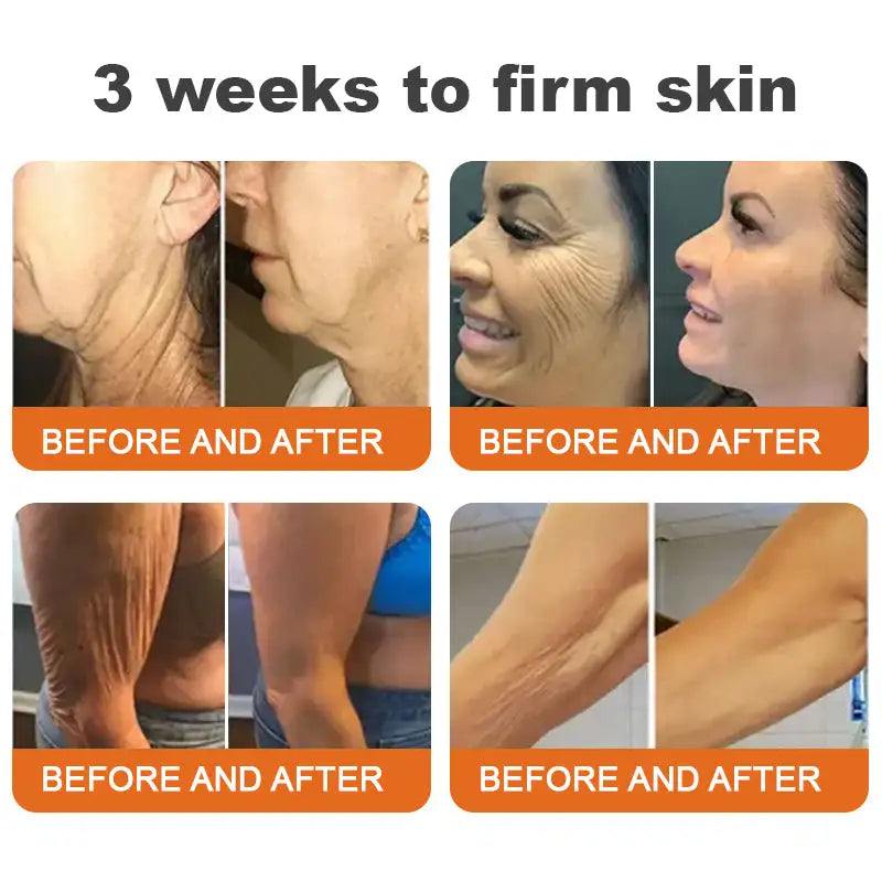 Flysmus™ Botox Bee Venom
