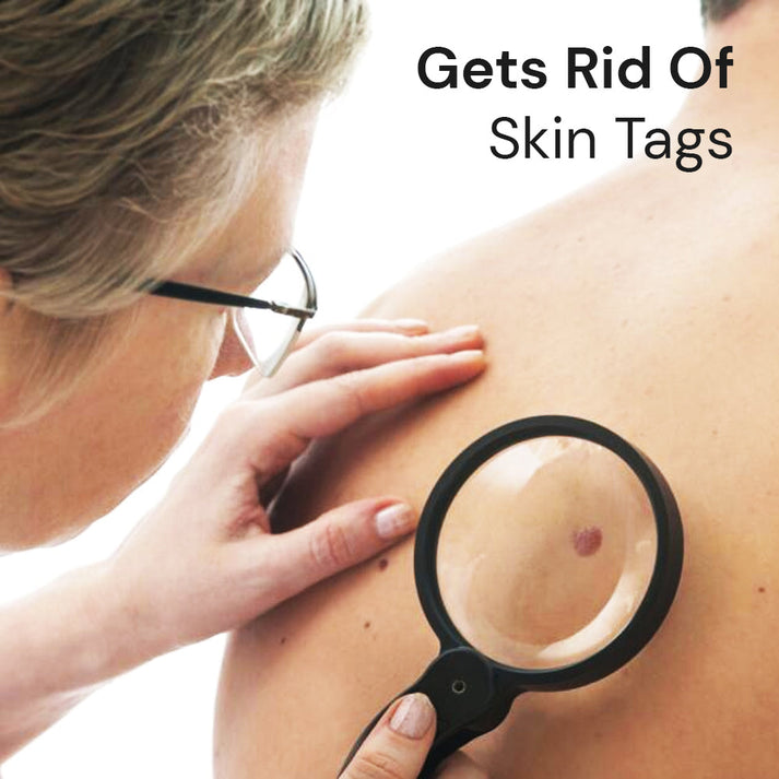 Wart-Remover