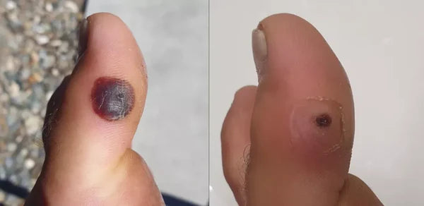 Wart-Remover