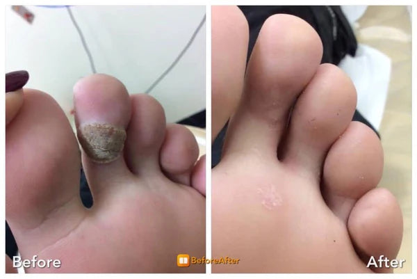 Wart-Remover
