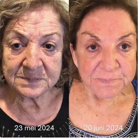 Anti-Falten Botox Gesichtsserum