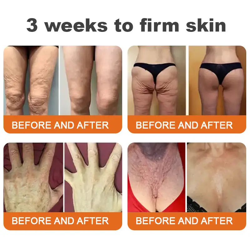 Flysmus™ Botox Bee Venom